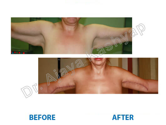 arm lift surgery in India
